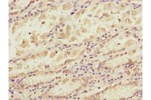 Immunohistochemistry of paraffin-embedded human gastric cancer using ABIN7145604 at dilution of 1:100 (BLOC1S2 Antikörper  (AA 44-142))