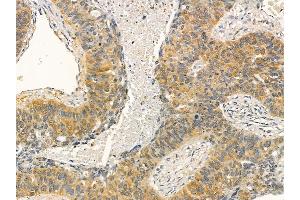 IREB1 Mouse Monoclonal Antibody at 1/100 staining human lung cancer and adjacent non-tumor tissue by IHC-P.