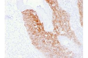 Formalin-fixed, paraffin-embedded human Cervix Carcinoma stained with CD44v6 Mouse Monoclonal Antibody (2F10). (CD44 Antikörper)