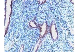 Formalin-fixed, paraffin-embedded human endometrial carcinoma stained with Cyclin B1 antibody (CCNB1/1098). (Cyclin B1 Antikörper)