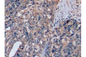 Detection of SCFR in Human Ovarian cancer Tissue using Polyclonal Antibody to Stem Cell Factor Receptor (SCFR)