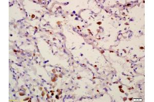 Formalin-fixed and paraffin embedded human lung carcinoma labeled with Anti-PPM1D Polyclonal Antibody, Unconjugated (ABIN740415) at 1:200 followed by conjugation to the secondary antibody and DAB staining (PPM1D Antikörper  (AA 201-300))
