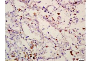 Formalin-fixed and paraffin embedded human lung carcinoma labeled with Anti-PPM1D Polyclonal Antibody, Unconjugated (ABIN740415) at 1:200 followed by conjugation to the secondary antibody and DAB staining