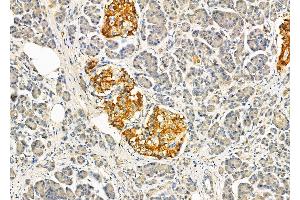ABIN6264314 and ABIN6274038 at 1/100 staining Human pancreatic cancer and adjacent nomal tissues by IHC-P. (Melanoma gp100 Antikörper  (C-Term))