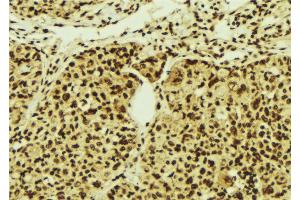 ABIN6274516 at 1/100 staining Human breast cancer tissue by IHC-P.