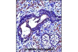 ACTG2 Antibody (C-term) (ABIN657460 and ABIN2846487) immunohistochemistry analysis in formalin fixed and paraffin embedded human prostate cancinoma followed by peroxidase conjugation of the secondary antibody and DAB staining.