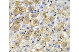 Immunohistochemistry of paraffin-embedded Human liver damage using Desmoplakin Polyclonal Antibody at dilution of 1:100 (40x lens).