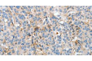 Immunohistochemistry of paraffin-embedded Human esophagus cancer using APOH Polyclonal Antibody at dilution of 1:30 (APOH Antikörper)
