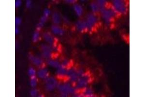 Immunofluorescence analysis of Human lung cancer tissue using CD68 Monoclonal Antibody at dilution of 1:200. (CD68 Antikörper)