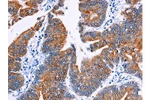 The image on the left is immunohistochemistry of paraffin-embedded Human colon cancer tissue using ABIN7130460(NR4A2 Antibody) at dilution 1/20, on the right is treated with fusion protein. (NR4A2 Antikörper)