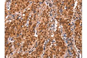 The image on the left is immunohistochemistry of paraffin-embedded Human gastic cancer tissue using ABIN7191185(KCNJ6 Antibody) at dilution 1/20, on the right is treated with synthetic peptide. (KCNJ6 Antikörper)