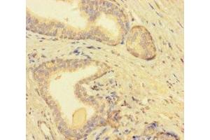 Immunohistochemistry of paraffin-embedded human prostate cancer using ABIN7173233 at dilution of 1:100 (TMEM52B Antikörper  (AA 61-183))