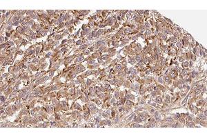 ABIN6279337 at 1/100 staining Human Melanoma tissue by IHC-P.