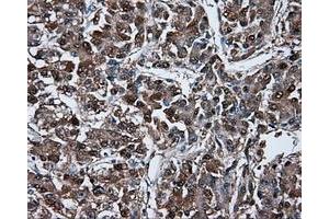 Immunohistochemical staining of paraffin-embedded Carcinoma of liver tissue using anti-BHMT mouse monoclonal antibody. (BHMT Antikörper)
