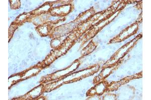 Formalin-fixed, paraffin-embedded human Renal Cell Carcinoma stained with KSP-Cadherin Rabbit Polyclonal Antibody.