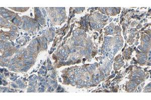ABIN6273629 at 1/100 staining Human cervical cancer tissue by IHC-P.