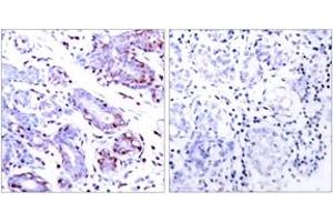Immunohistochemistry analysis of paraffin-embedded human breast carcinoma tissue, using STAT1 (Ab-701) Antibody. (STAT1 Antikörper  (AA 668-717))