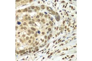 Immunohistochemistry of paraffin-embedded human esophageal cancer using HDAC2 antibody. (HDAC2 Antikörper  (C-Term))