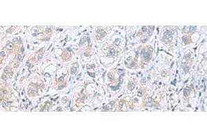 Immunohistochemistry of paraffin-embedded Human liver cancer tissue using GPCPD1 Polyclonal Antibody at dilution of 1:55(x200) (GPCPD1 Antikörper)