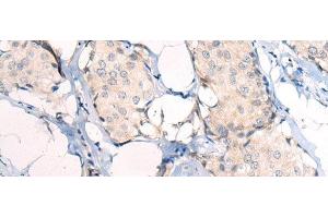 Immunohistochemistry of paraffin-embedded Human breast cancer tissue using ANAPC15 Polyclonal Antibody at dilution of 1:50(x200)
