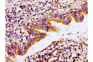 Immunohistochemistry of paraffin-embedded human lung cancer using ABIN7143021 at dilution of 1:100 (ACO2 Antikörper  (AA 452-676))
