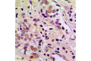 Immunohistochemical analysis of AATF staining in human breast cancer formalin fixed paraffin embedded tissue section.