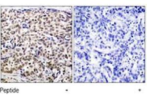 Immunohistochemical analysis of paraffin-embedded human breast carcinoma tissue using CREB1 polyclonal antibody  . (CREB1 Antikörper  (Ser129))