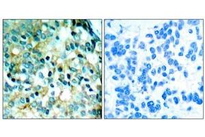 Immunohistochemical analysis of paraffin- embedded human breast carcinoma tissue using Src (phospho- Tyr418) antibody. (Src Antikörper  (pTyr418))