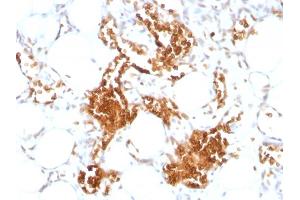 Formalin-fixed, paraffin-embedded human Angiosarcoma stained with Glycophorin A Monoclonal Antibody (SPM599) (CD235a/GYPA Antikörper)