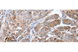 Immunohistochemistry of paraffin-embedded Human breast cancer tissue using CALB2 Polyclonal Antibody at dilution of 1:25(x200) (Calretinin Antikörper)