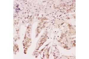 Anti-ATF1 Picoband antibody,  IHC(P): Human Intestinal Cancer Tissue (AFT1 Antikörper  (AA 1-271))