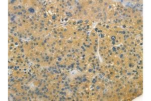 ABIN6257374 and ABIN6273951 at 1/100 staining human hepatocellular carcinoma by IHC-P. (NMUR2 Antikörper  (C-Term))