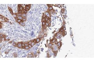 ABIN6272741 at 1/100 staining Human Head and neck cancer tissue by IHC-P. (TAS2R38 Antikörper  (Internal Region))