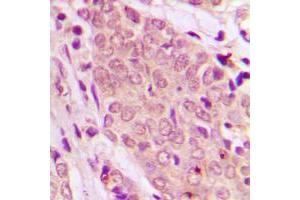 Immunohistochemical analysis of SMAD2/3 staining in human breast cancer formalin fixed paraffin embedded tissue section.