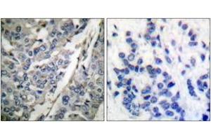 Immunohistochemistry analysis of paraffin-embedded human breast carcinoma, using Synaptotagmin (Phospho-Thr202) Antibody. (Synaptotagmin Antikörper  (pThr202))