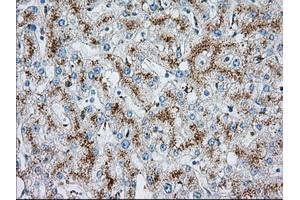 Immunohistochemical staining of paraffin-embedded Carcinoma of liver tissue using anti-MTRF1L mouse monoclonal antibody.