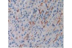 IHC-P analysis of Human Prostate Gland Cancer Tissue, with DAB staining. (FLNC Antikörper  (AA 17-259))