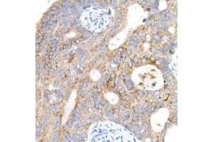 Immunohistochemistry of paraffin-embedded human colon carcinoma using Cation-independent M6PR (IGF2R) antibody (ABIN7267905) at dilution of 1:200 (40x lens). (IGF2R Antikörper)