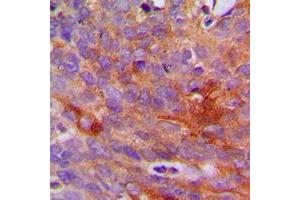 Immunohistochemical analysis of Collagen 1 alpha 2 staining in human breast cancer formalin fixed paraffin embedded tissue section. (COL1A2 Antikörper  (N-Term))