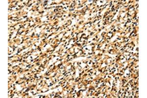 The image on the left is immunohistochemistry of paraffin-embedded Human prostate cancer tissue using ABIN7131054(SIGLEC12 Antibody) at dilution 1/35, on the right is treated with fusion protein. (SIGLEC12 Antikörper)