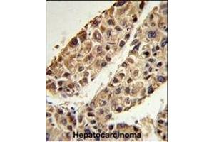 Formalin-fixed and paraffin-embedded human hepatocarcinoma reacted with ITIH2 Antibody (C-term), which was peroxidase-conjugated to the secondary antibody, followed by DAB staining. (ITIH2 Antikörper  (C-Term))