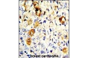 Formalin-fixed and paraffin-embedded human breast carcinoma with P19 Antibody (C-term), which was peroxidase-conjugated to the secondary antibody, followed by DAB staining. (MMP19 Antikörper  (C-Term))