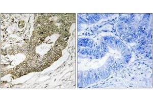 Immunohistochemistry analysis of paraffin-embedded human colon carcinoma tissue, using NUCKS1 Antibody.