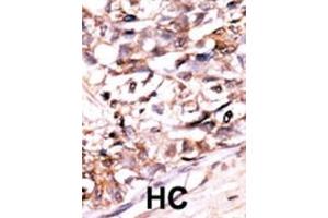 Formalin-fixed and paraffin-embedded human cancer tissue reacted with the primary antibody, which was peroxidase-conjugated to the secondary antibody, followed by AEC staining. (DUSP13-M1 (AA 1-30), (N-Term) Antikörper)