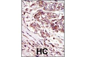 Formalin-fixed and paraffin-embedded human cancer tissue reacted with the primary antibody, which was peroxidase-conjugated to the secondary antibody, followed by AEC staining. (CAMK1G Antikörper  (C-Term))