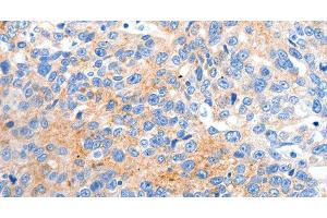 Immunohistochemistry of paraffin-embedded Human ovarian cancer tissue using HCN2 Polyclonal Antibody at dilution 1:80 (HCN2 Antikörper)