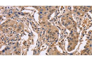 Immunohistochemistry of paraffin-embedded Human lung cancer using IDH1 Polyclonal Antibody at dilution of 1:50 (IDH1 Antikörper)