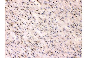 Beta III Tubulin was detected in paraffin-embedded sections of human glioma tissues using rabbit anti- Beta III Tubulin Antigen Affinity purified polyclonal antibody (Catalog # ) at 1 µg/mL. (TUBB3 Antikörper  (C-Term))
