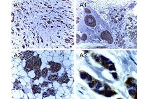 Immunohistochemical analysis of BIRC4 in formalin-fixed, paraffin-embedded human breast carcinoma.