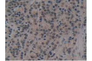 IHC-P analysis of Human Prostate Gland Cancer Tissue, with DAB staining. (ATG7 Antikörper  (AA 429-488))